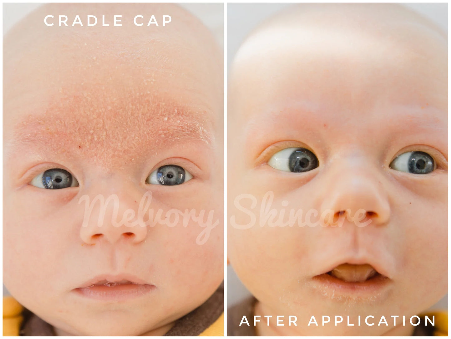 Before and after comparison of a baby's skin with cradle cap and after application of Melvry Shine.