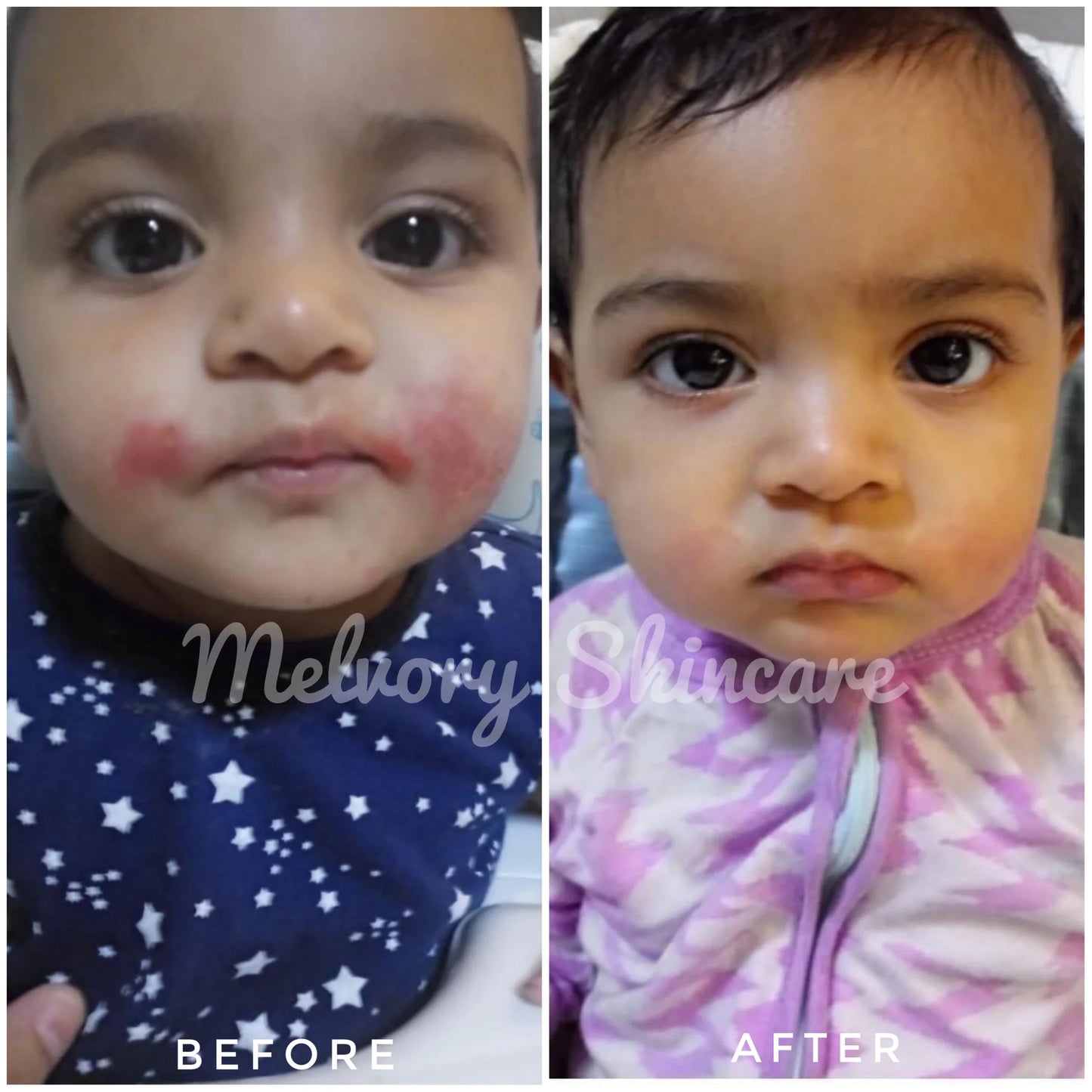 Before and after comparison of a child's skin with Melvior Skincare