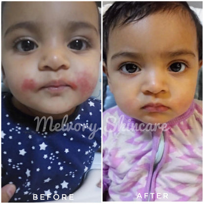 Before and after comparison of a child's skin with Melvior Skincare