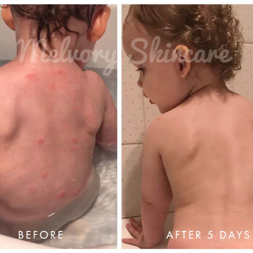 Before and after comparison of a child's skin with Melvory Skincare on a tiled bathroom wall background.