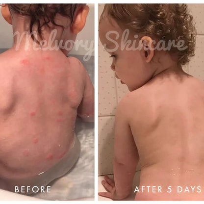Before and after comparison of a child's skin with Melvory Skincare on a tiled bathroom wall background.