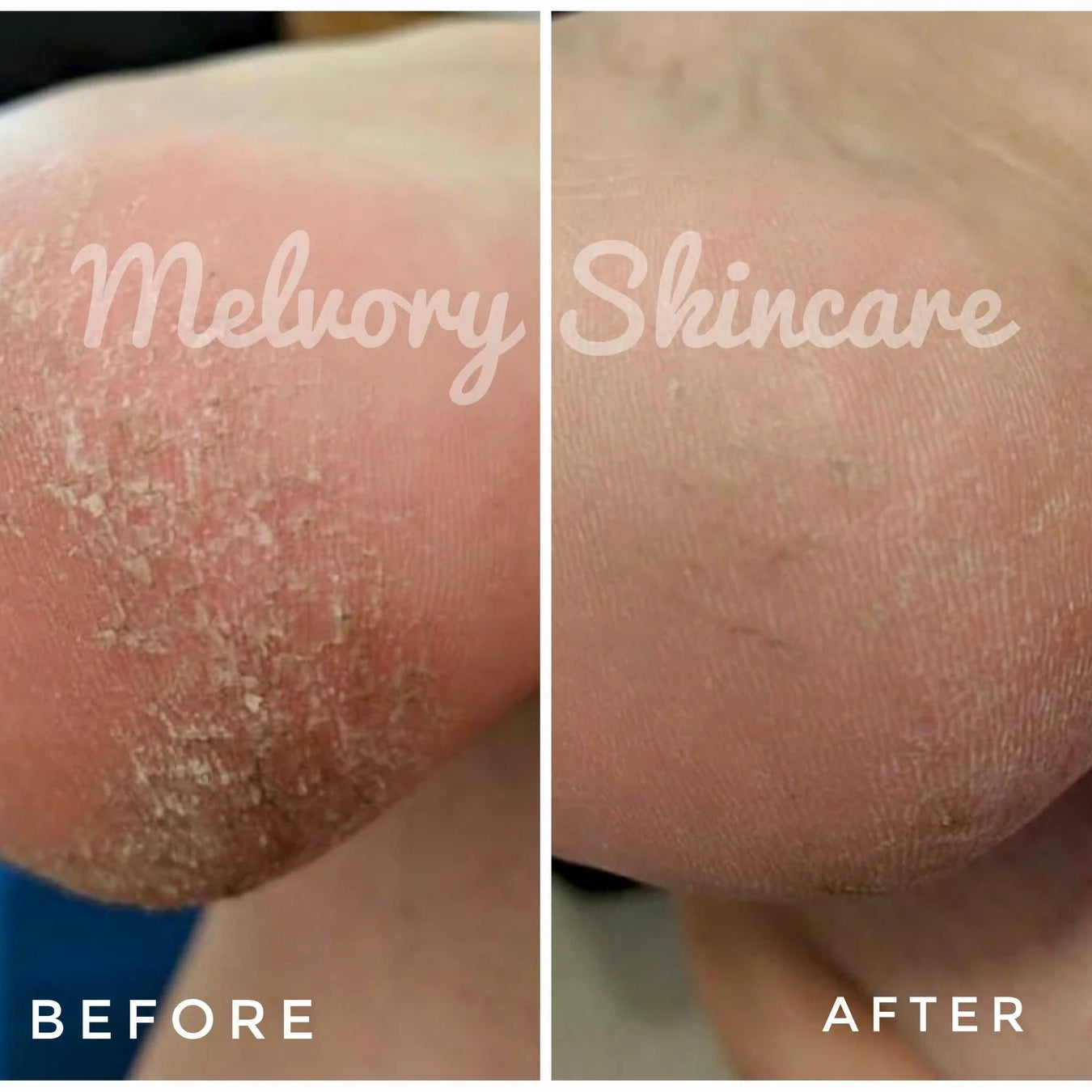 Before and after comparison of Melvory Skincare on a person's skin.
